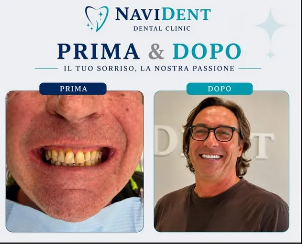 NaviDent Clinic Tirana — caso reale prima e dopo: impianti e protesi