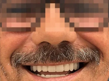 Dopo